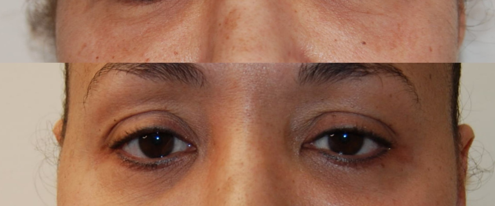 How long does it take for morpheus8 to work after 3 treatments?