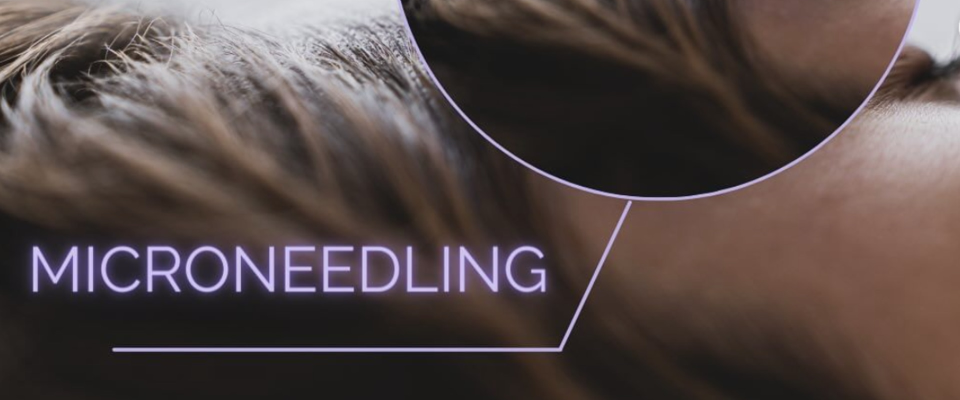 Morpheus8 vs Secret RF: Which is the Better Skin Tightening Treatment?