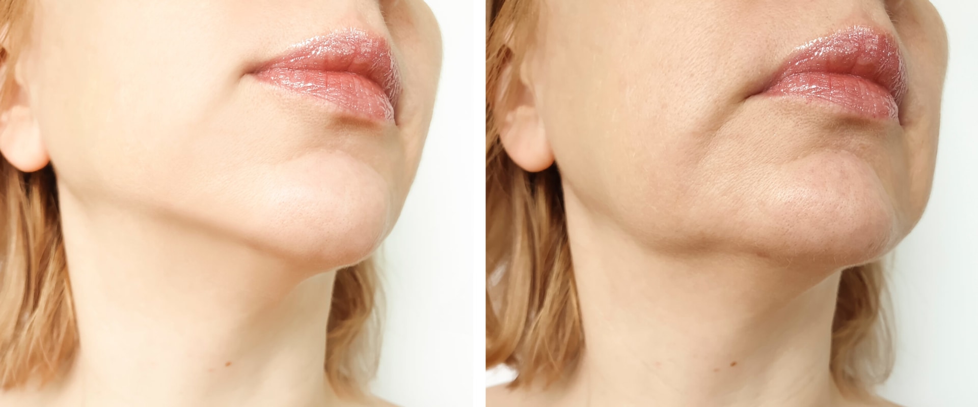 Can You See Results After One Morpheus8 Treatment?