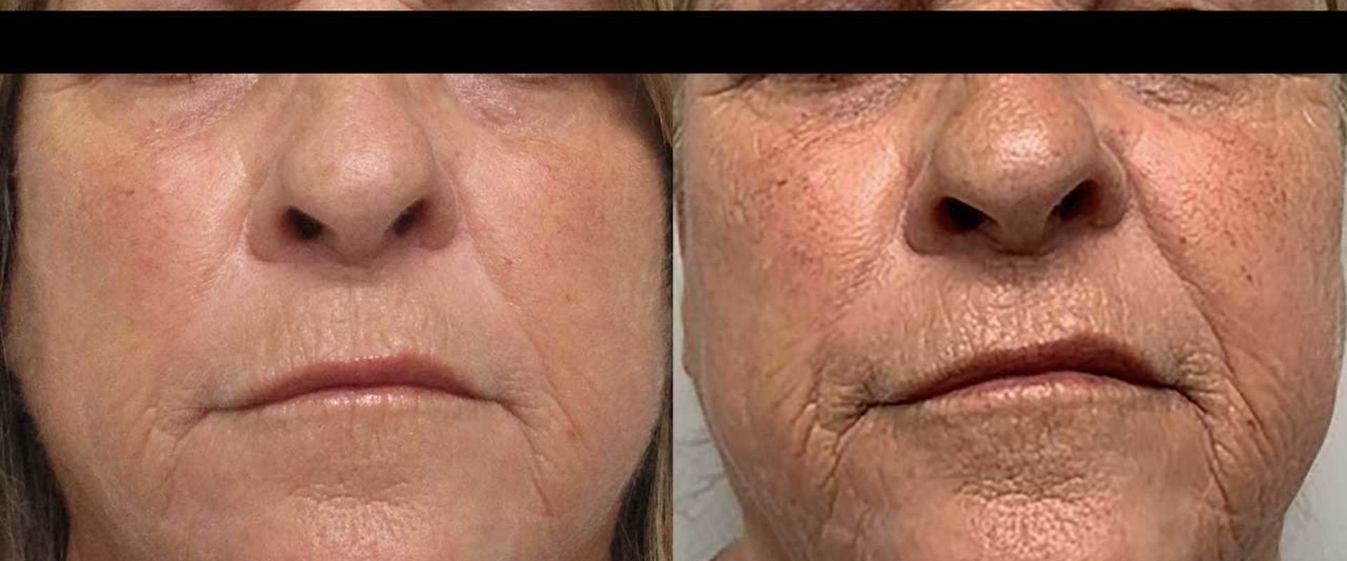 The Ultimate Guide to Morpheus8: How Long Does it Take for Morpheus8 to Tighten Skin?