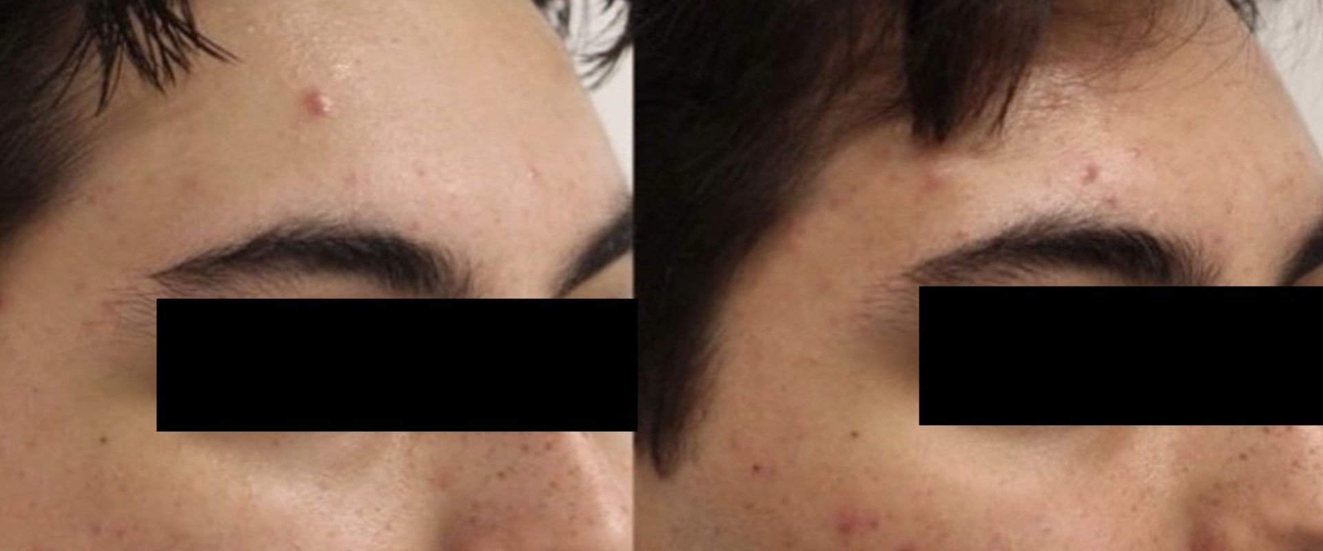 Which is better microneedling or morpheus8?