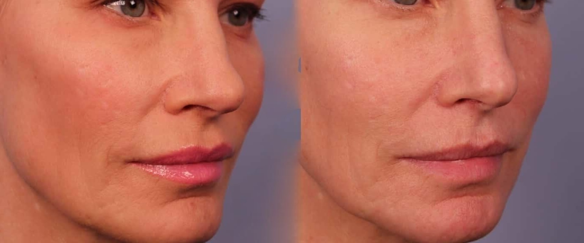 How soon do you see morpheus8 results?