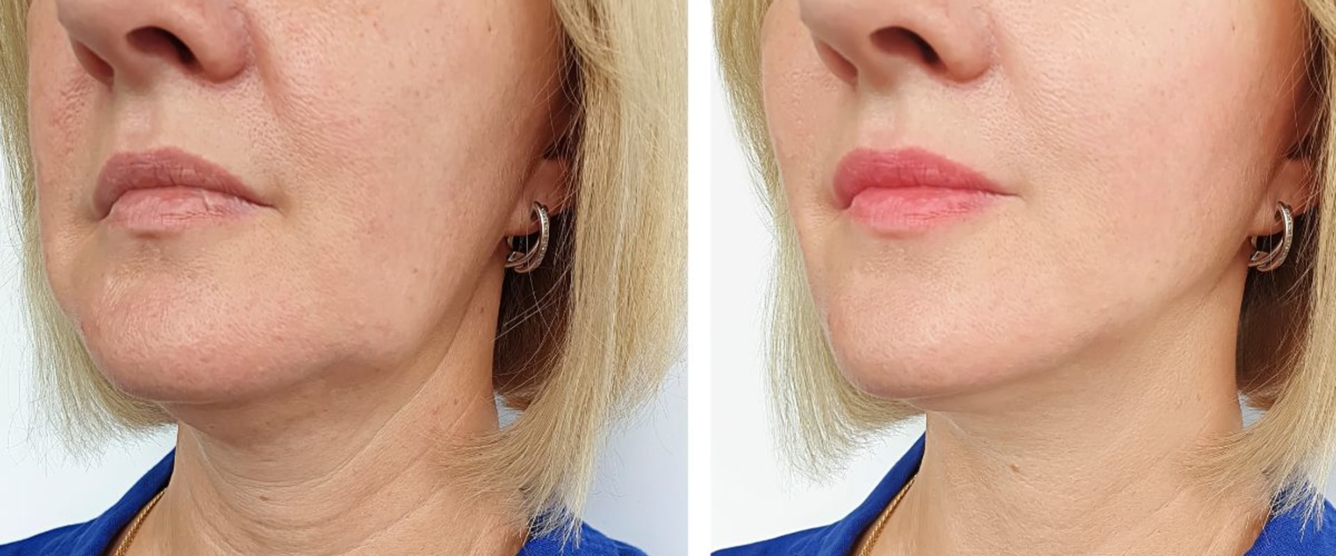The Power of Profound RF Microneedles