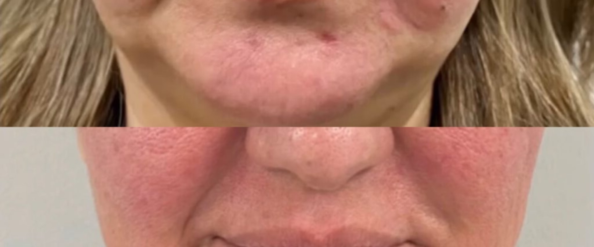 How long do morpheus8 grid marks last?