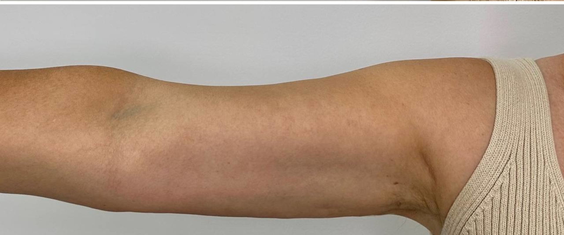 Does morpheus8 work on upper arms?