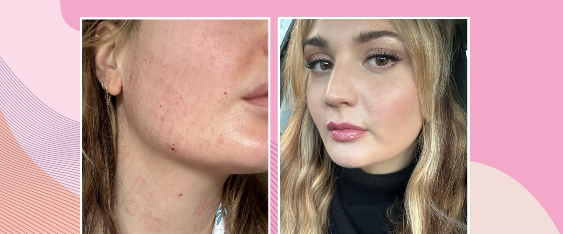 Morpheus8: The Risks and Benefits of This Popular Skin Treatment