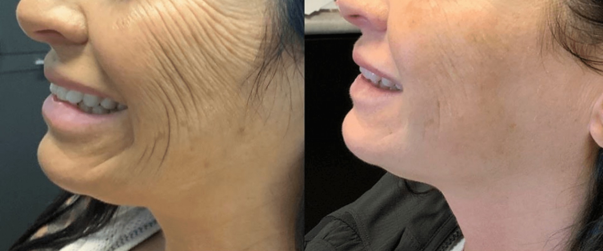 How long should you wait between morpheus8 treatments?