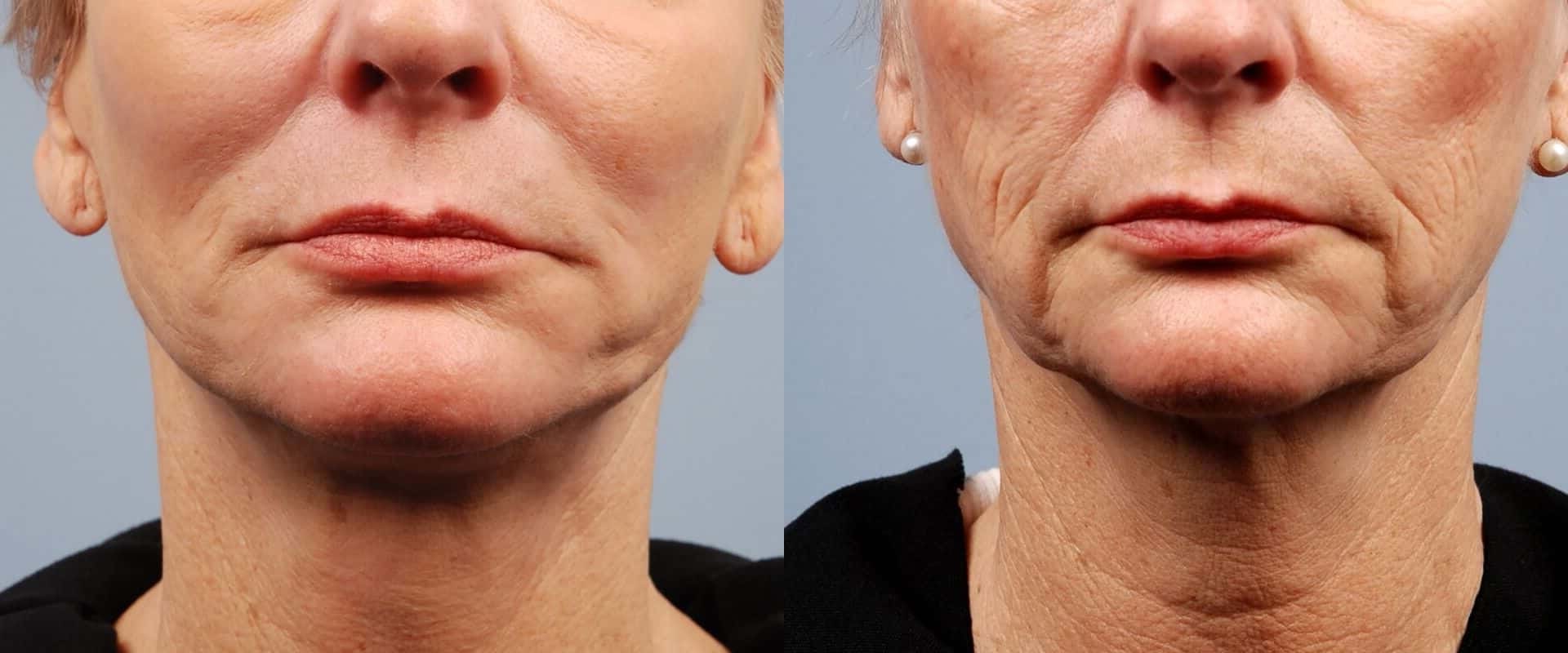 The Power of Morpheus8: A Comprehensive Guide to the Revolutionary Skin Treatment