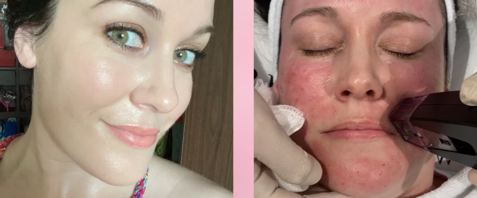 What does skin look like immediately after morpheus8?