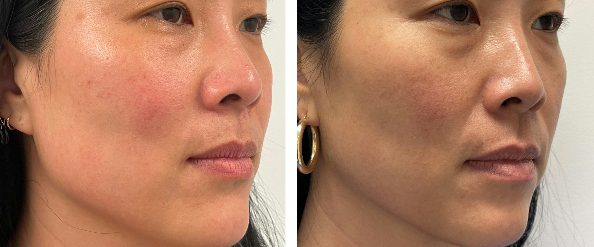 The Ultimate Guide to Morpheus8 Skin Tightening