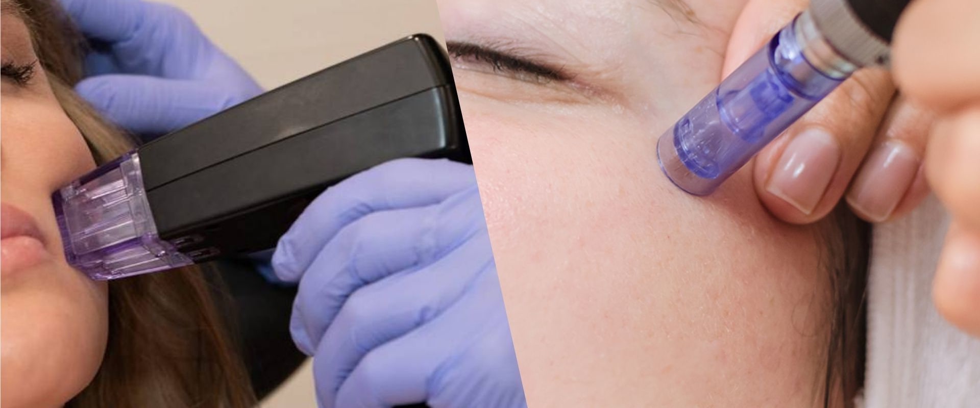 Morpheus8 vs SkinPen: Which Microneedling Treatment is Right for You?