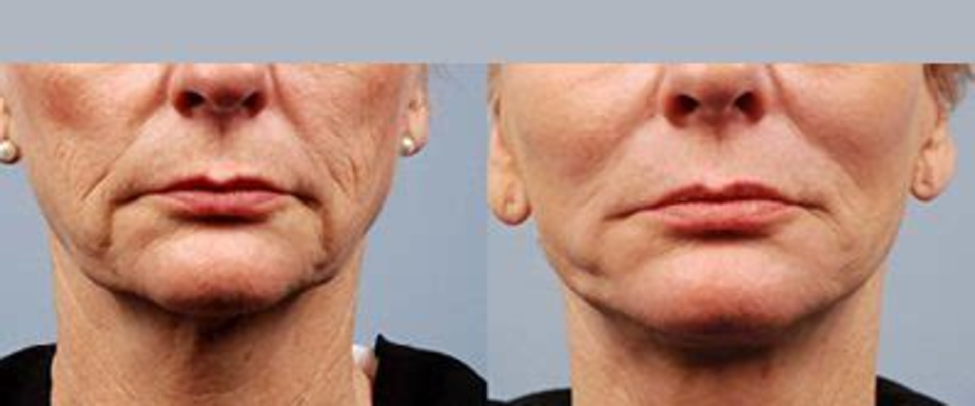 Why Morpheus8 and Regenerative Aesthetics Are Reshaping Modern Skin Rejuvenation