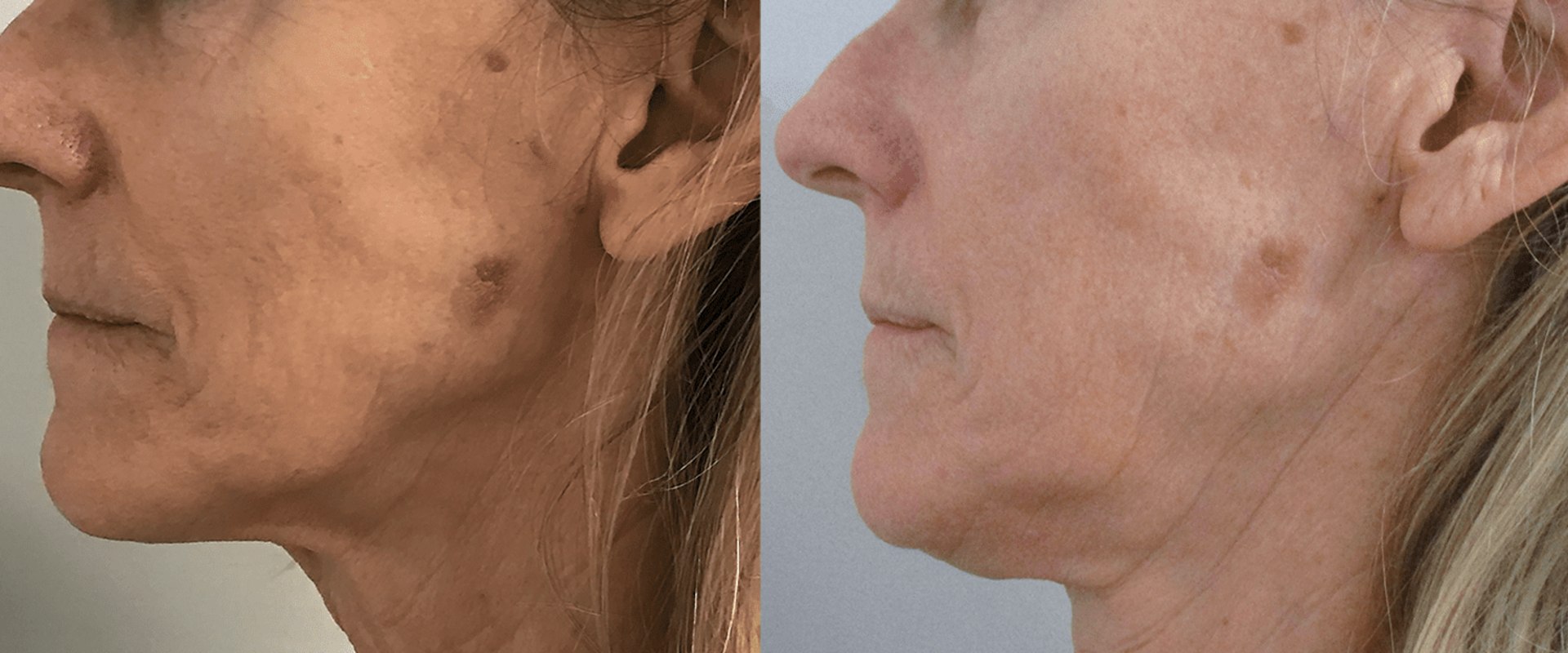 Does Morpheus8 Work on Older Skin?