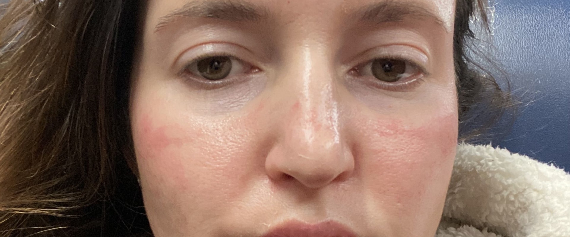 The Ultimate Guide to Choosing Between Morpheus8 and CO2 Laser