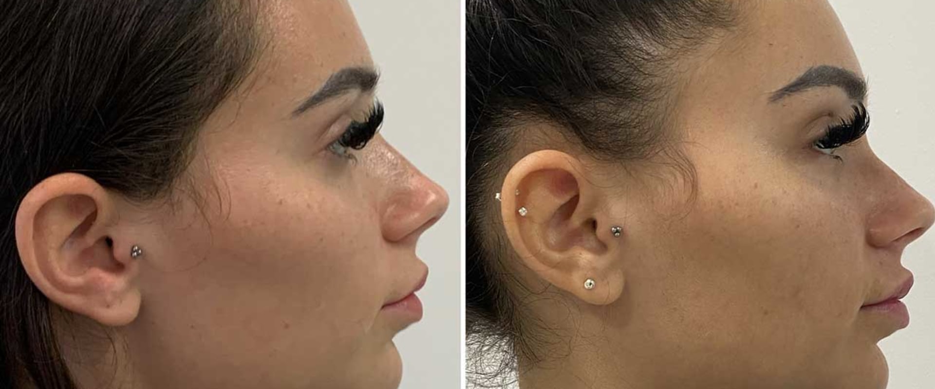 How much does facetite with morpheus8 cost?