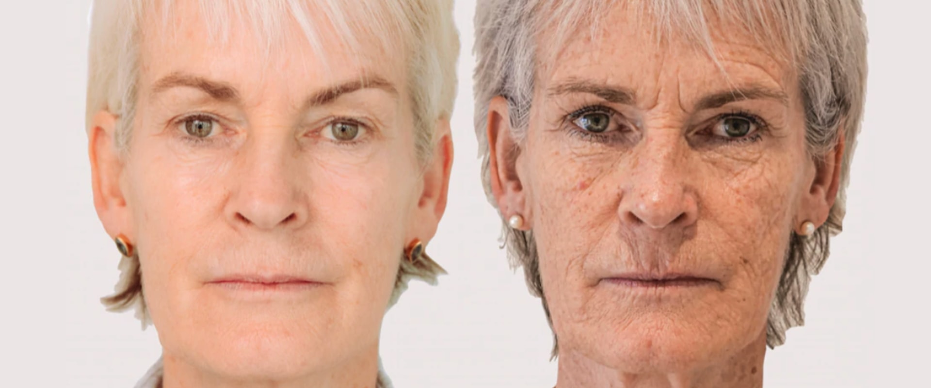 Does morpheus8 work on older people?
