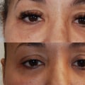 How long does it take for morpheus8 to work after 3 treatments?