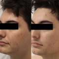 Which is better microneedling or morpheus8?