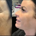 How long should you wait between morpheus8 treatments?