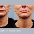 Why Morpheus8 and Regenerative Aesthetics Are Reshaping Modern Skin Rejuvenation