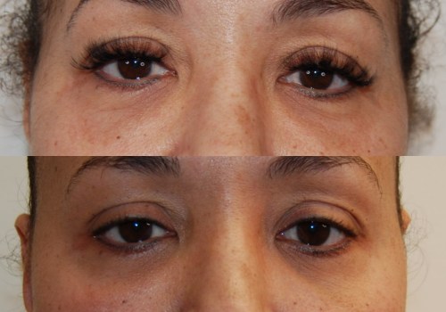 How long does it take for morpheus8 to work after 3 treatments?