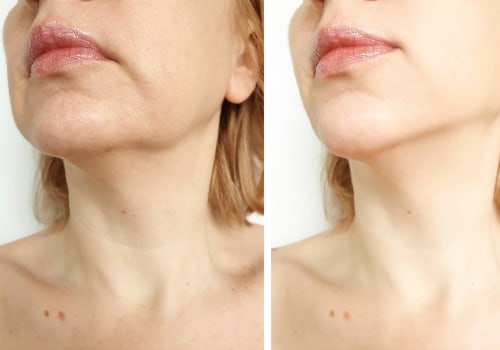 Can You See Results After One Morpheus8 Treatment?