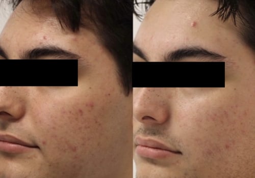 Which is better microneedling or morpheus8?