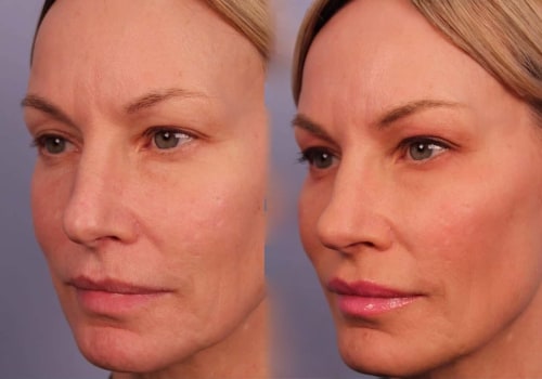 How soon do you see morpheus8 results?