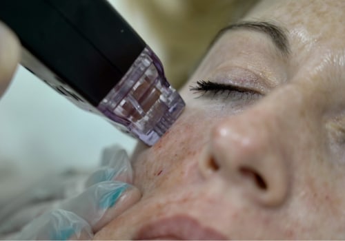 How long does it take for the face to heal after morpheus8?