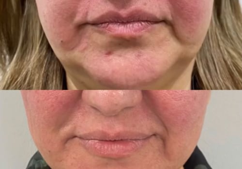 How long do morpheus8 grid marks last?