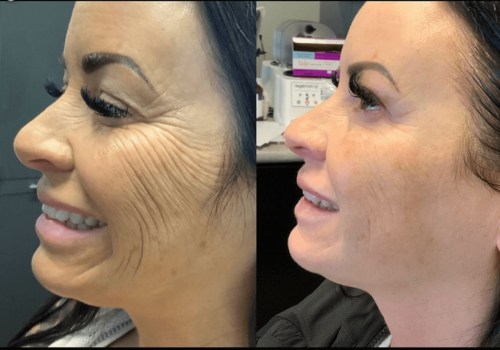 How long should you wait between morpheus8 treatments?