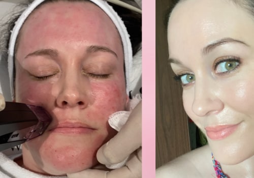 What does skin look like immediately after morpheus8?