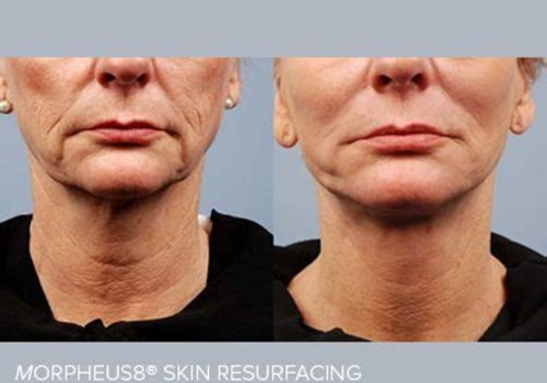 Why Morpheus8 and Regenerative Aesthetics Are Reshaping Modern Skin Rejuvenation