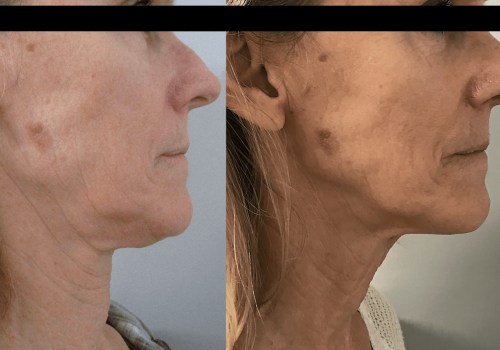 Does Morpheus8 Work on Older Skin?