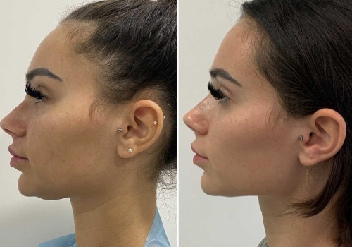 How much does facetite with morpheus8 cost?